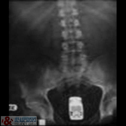 X光片展示“肛门内的10大不可思议”